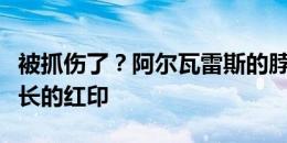 被抓伤了？阿尔瓦雷斯的脖子上出现了一道长长的红印