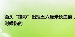 额头“挂彩”出现五六厘米长血痕，吴曦：我也不知道什么时候伤的