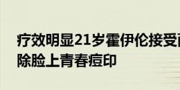 疗效明显21岁霍伊伦接受面部激光治疗，去除脸上青春痘印